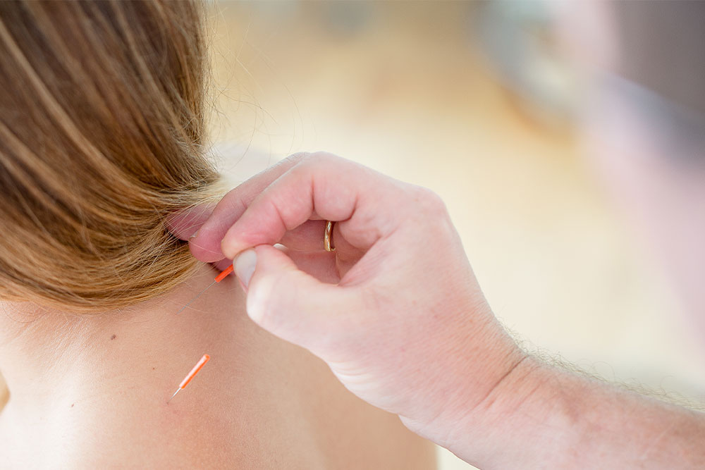 Nadelstiche in die Halswirbelsäule zur therapeutischen Behandlung bei OCS Düsseldorf"